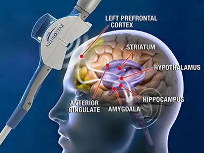 TMS Therapy